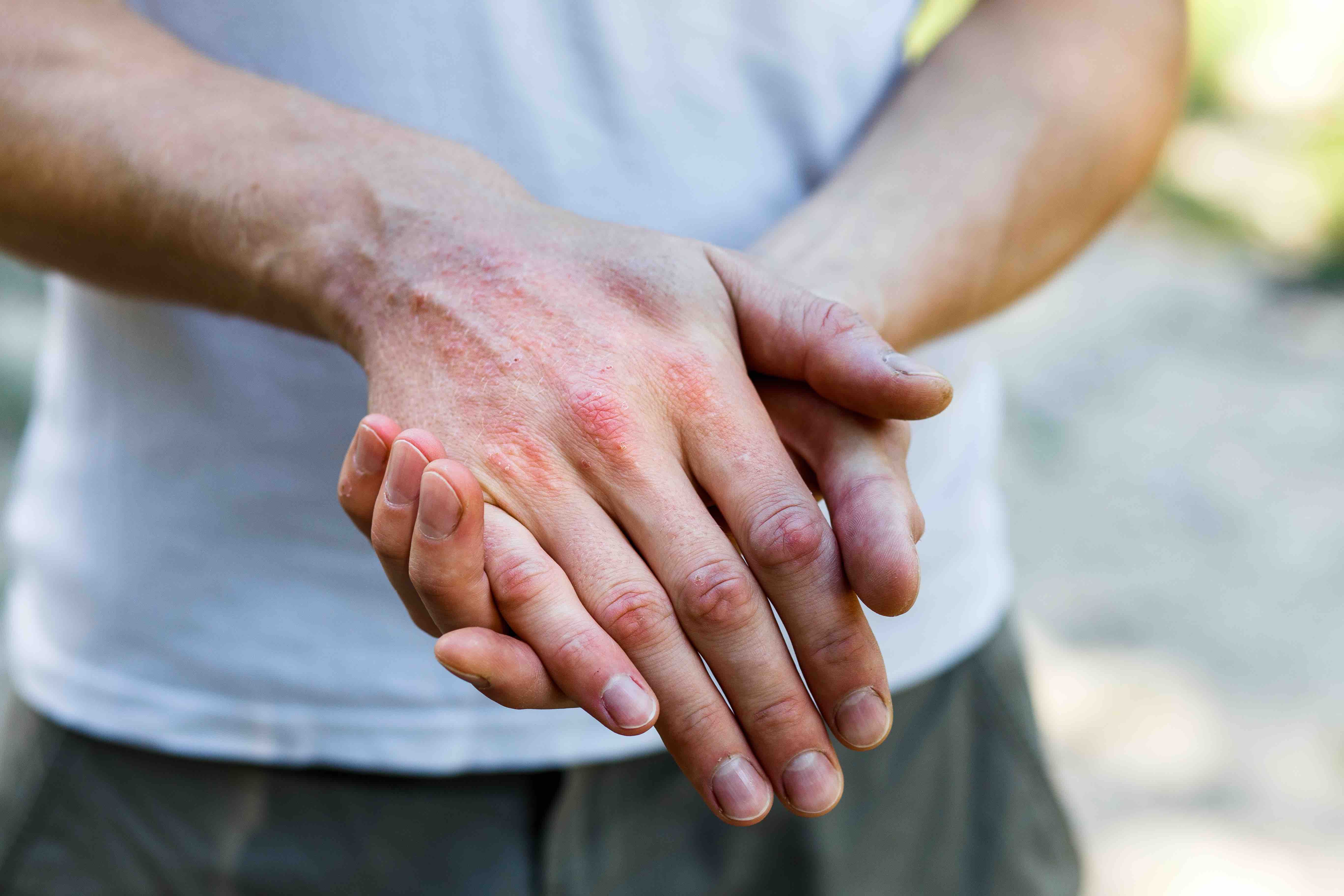 Atopic dermatitis | Image credit: Ольга Тернавская - stock.adobe.com