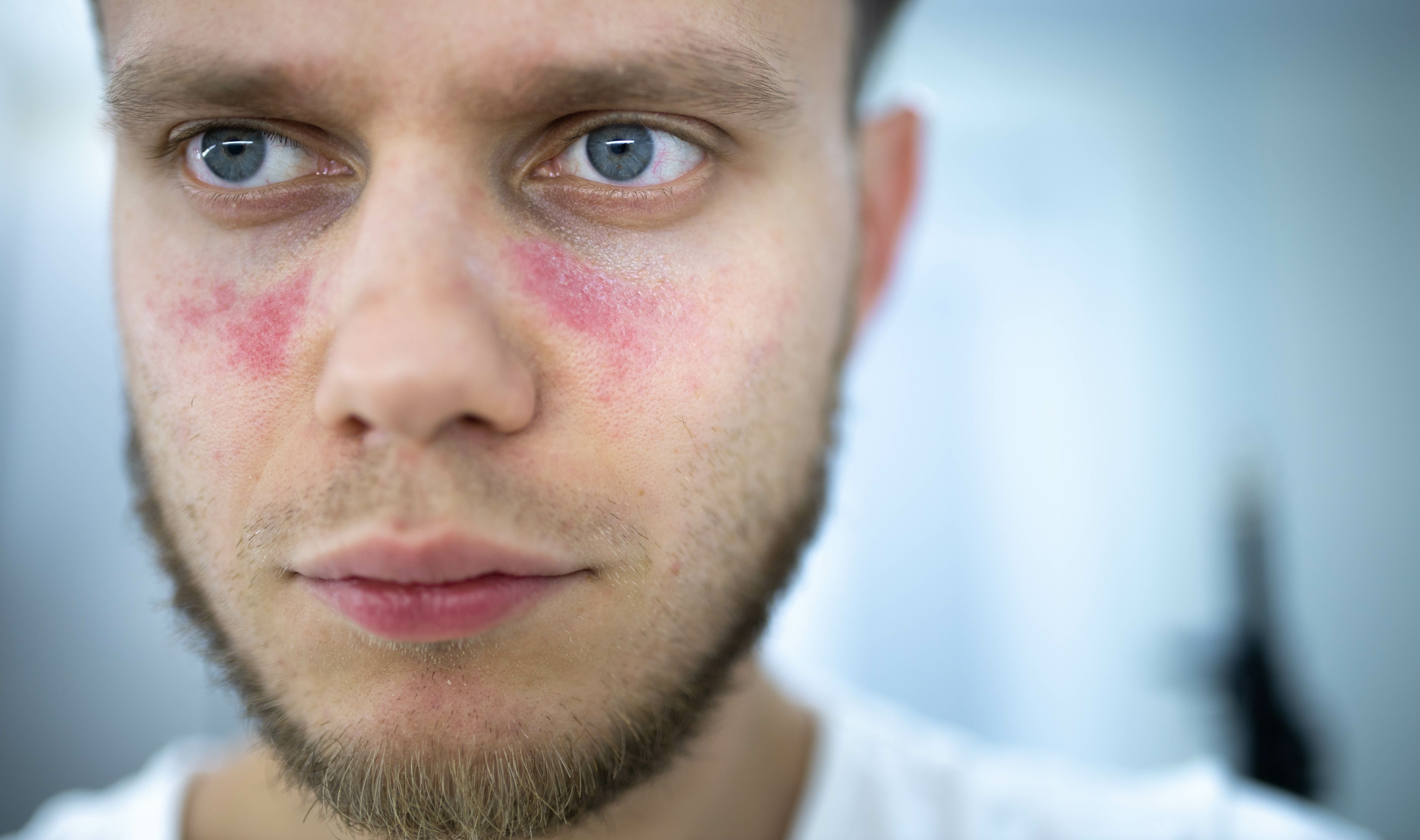Man With Lupus Erythematosus | image credit: velimir - stock.adobe.com