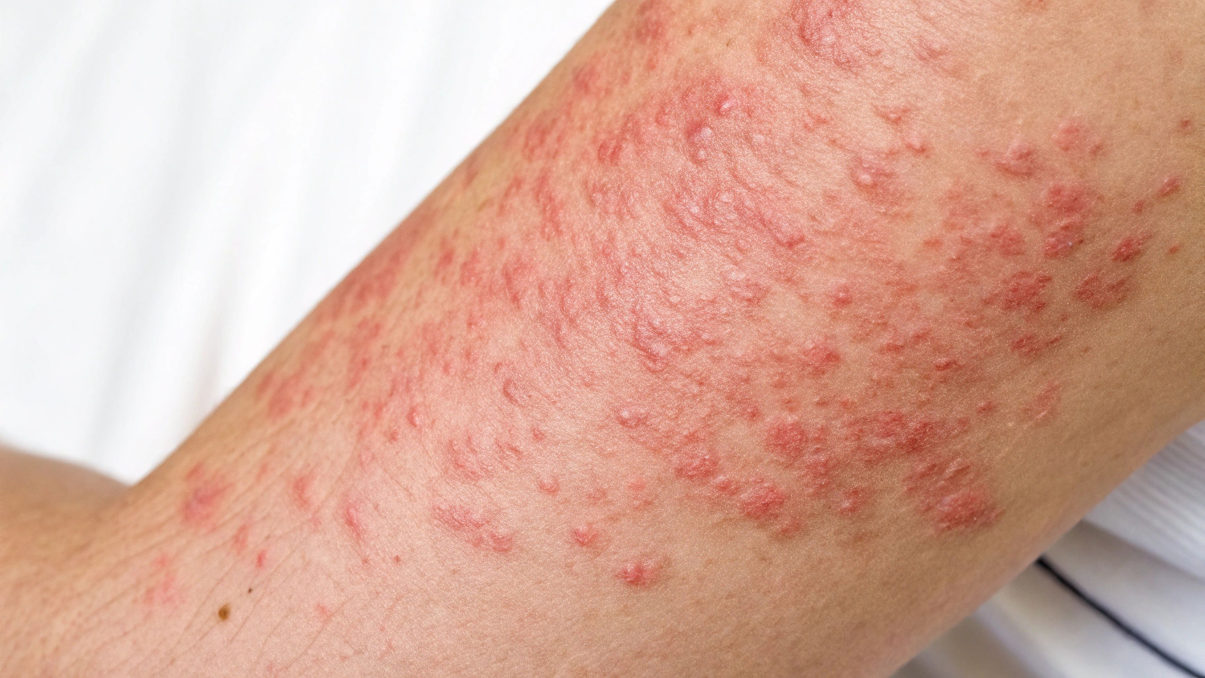 Chronic urticaria. | Image Credit: Cuoregentile - stock.adobe.com