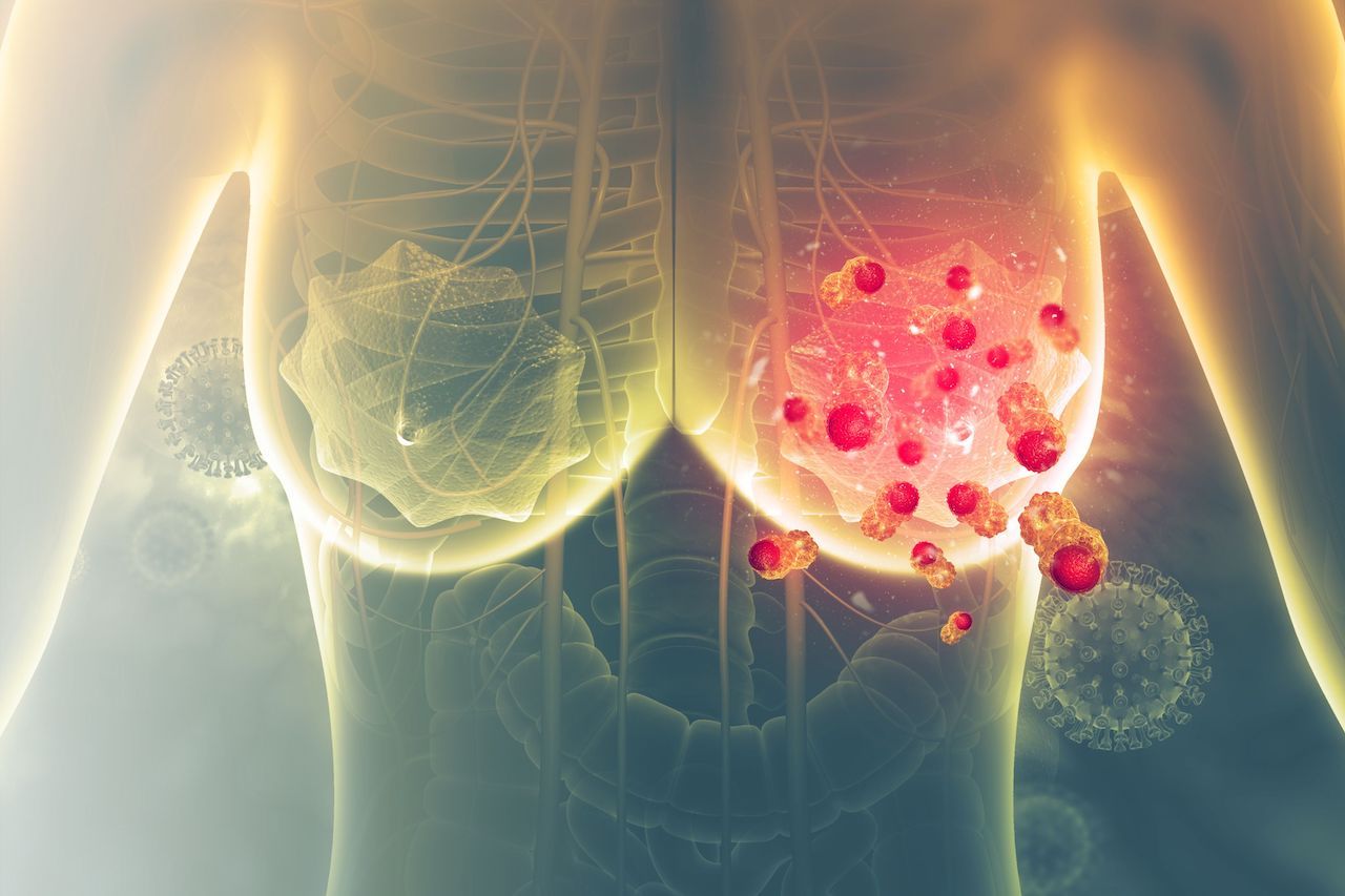 Breast cancer - Crystal light - stock.adobe.com