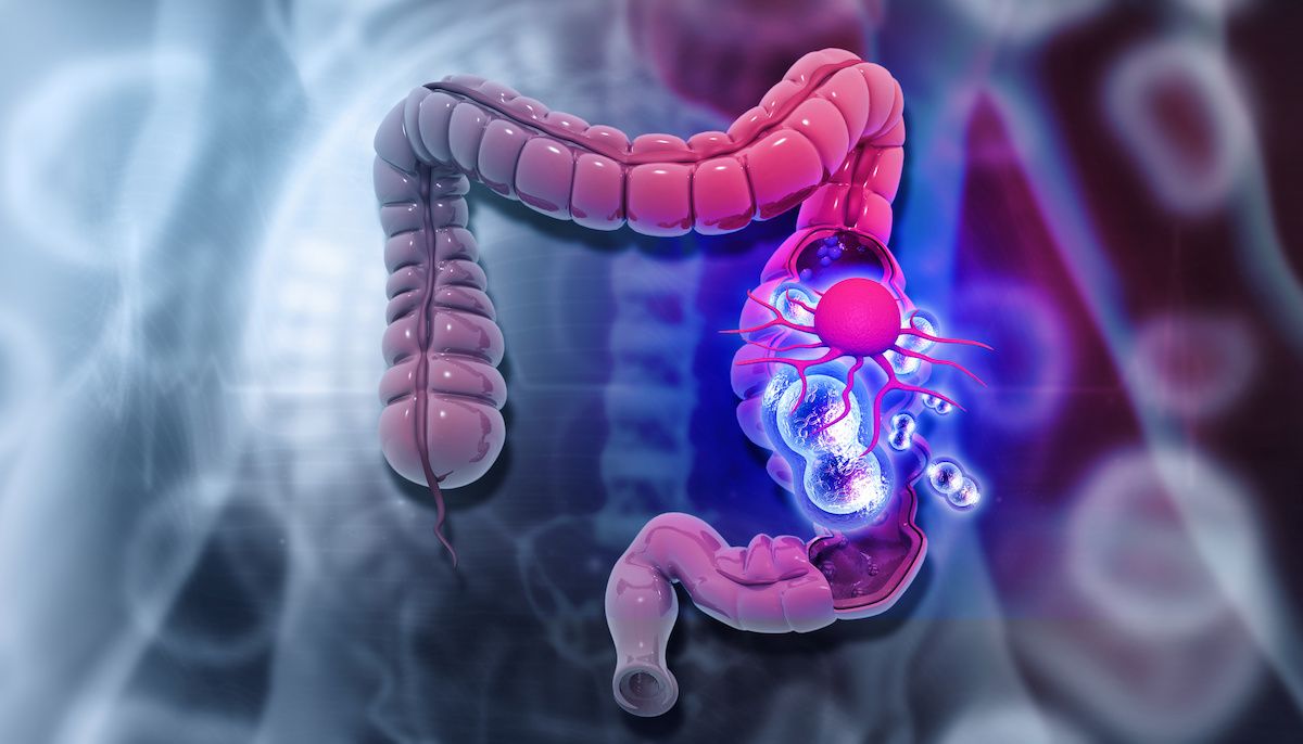 colorectal cancer | Image credit: Rasi - stock.adobe.com
