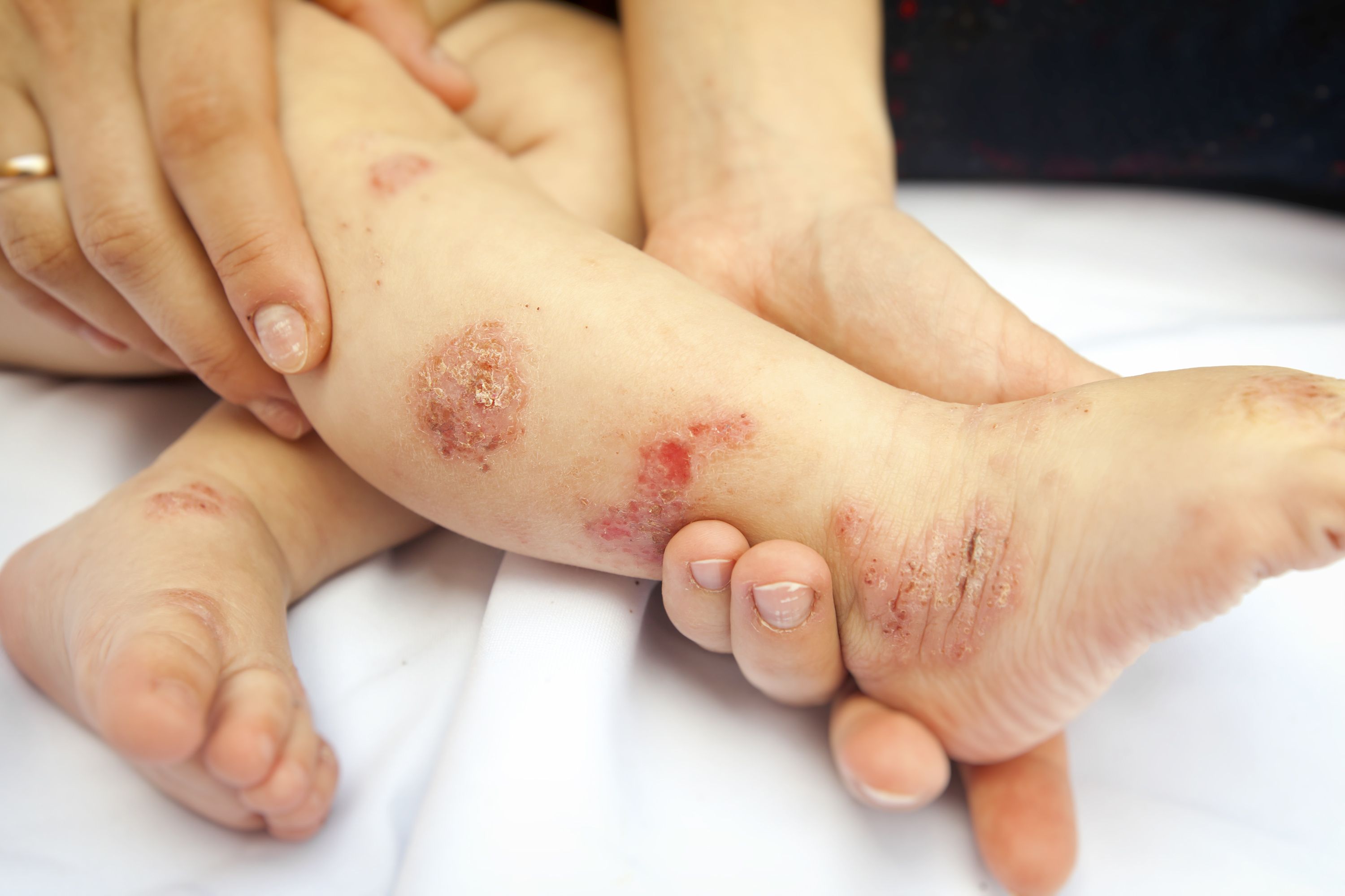 Retrospective Study Examines Dupilumab Performance in Asian Youth Population